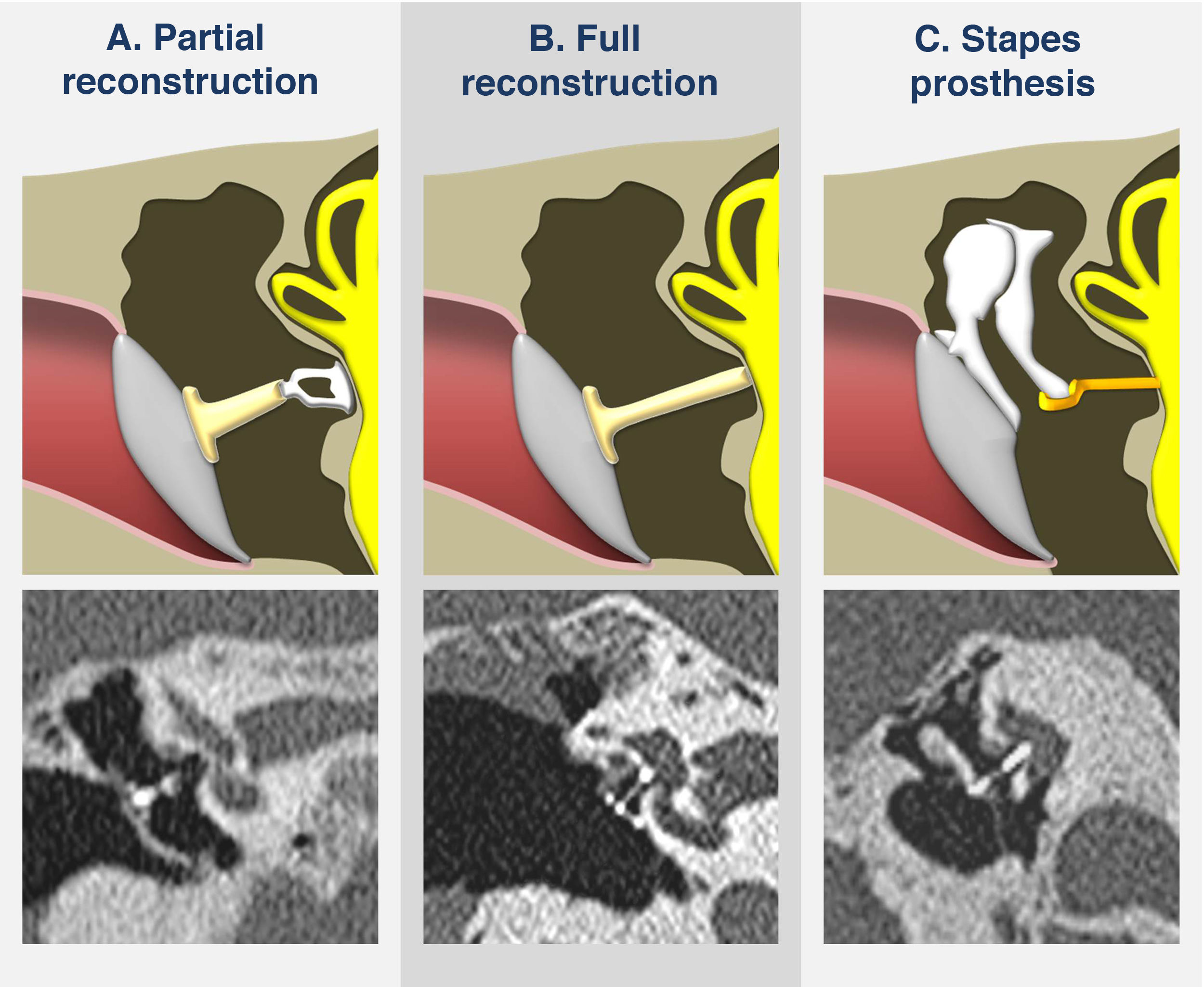 Radiological evaluation of the postsurgical middle ear | Radiología ...
