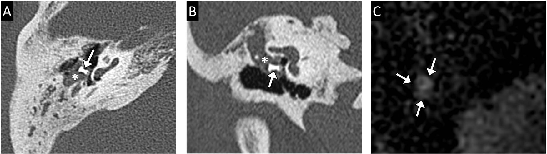 Radiological evaluation of the postsurgical middle ear | Radiología ...