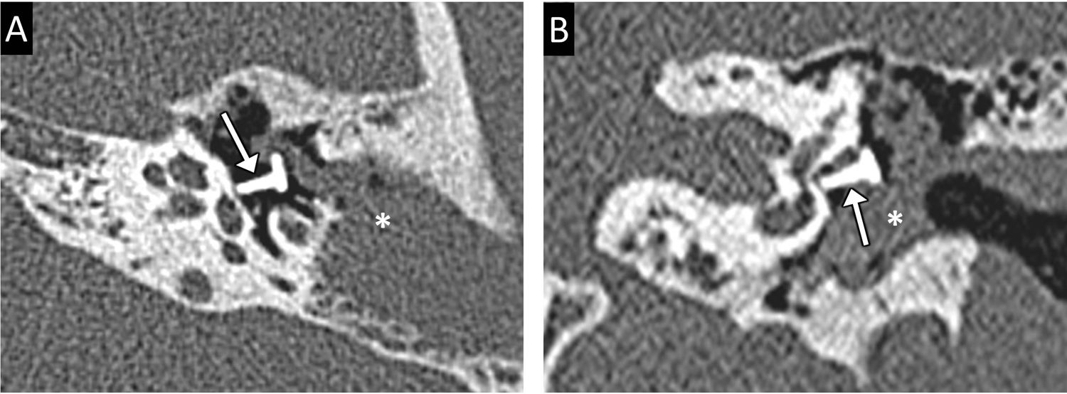 Radiological evaluation of the postsurgical middle ear | Radiología ...