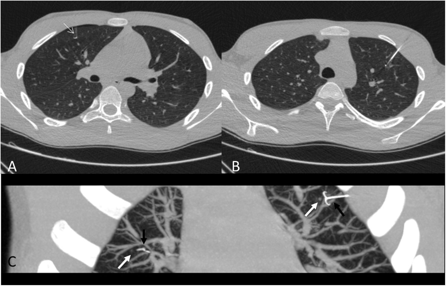 CT-guided hook-wire localization of pulmonary nodules in children prior ...