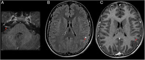 A 15-year-old patient who had fever for a month. Right peripheral facial paralysis, headache, dizziness and a sensation of stiffness in the neck and back subsequently developed. The patient was diagnosed with facial paralysis secondary to neuroborreliosis. (A and C) Axial T1-weighted imaging after intravenous contrast administration. (B) Axial imaging on a FLAIR sequence. Magnetic resonance imaging showed greater uptake by the right facial nerve in the internal auditory canal and intrapetrous course on a T1-weighted sequence with contrast (A). Round subcortical millimetric punctiform focus in the left parietal lobe, hyperintense on FLAIR (B) and exhibiting contrast uptake on T1 (C).
