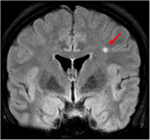 A 27-year-old woman with migraine who visited the hospital after a new episode of migraine with transient right hypoaesthesia. Coronal imaging on a FLAIR sequence. Magnetic resonance imaging showed a small focus hyperintense on FLAIR in the white matter of the left centrum semiovale.