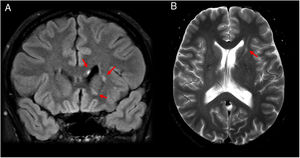A 36-year-old patient with sarcoidosis who experienced an episode of hearing loss, facial paralysis and right hypoaesthesia. (A) Axial T2-weighted imaging. (B) Coronal imaging on a FLAIR sequence. Small foci hyperintense on T2/FLAIR are seen in the corpus callosum (A) and internal capsule (A and B). This case showed no pachymeningeal enhancement, leptomeningeal enhancement or thickening of the pituitary stalk (infundibulum), with MRI findings being highly non-specific.