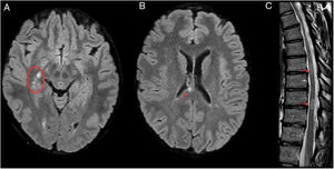 A 29-year-old patient admitted to neurology with hyperreflexia and lower limb paraesthesia was initially diagnosed with relapsing–remitting multiple sclerosis with partial response to treatment. However, laboratory testing revealed persistent positivity for IgM; hence, a decision was made to administer antibiotic therapy (doxycycline), after which the patient’s symptoms completely subsided in a month. Four years later, the patient has not experienced any recurrent symptoms or presented any new lesions on magnetic resonance imaging (MRI). MRI prior to antibiotic therapy. (A and B) Axial imaging on a FLAIR sequence. (C) T2-weighted sagittal imaging. MRI showed several hyperintense lesions on FLAIR sequences with an oval morphology in the right thalamic mesencephalic sulcus (A), corpus callosum (B), cervical spine (C3, C4 and C5) and thoracic spine (T7–T8 and T9–T10) (C).