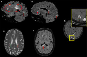 A 53-year-old patient with hemiplegia, headache and instability with positive serology for Borrelia. (A, B and D) Sagittal and axial imaging on a FLAIR sequence. (C) Axial T2-weighted imaging. (E) Axial T1-weighted imaging after intravenous contrast administration. Magnetic resonance imaging showed hyperintense lesions on T2/FLAIR in the periventricular white matter, coronae radiatae and splenium of the corpus callosum with no enhancement (A–D). A ring-enhancing lesion hyperintense on T2/FLAIR in a right occipital juxtacortical location was seen (E). The cerebrospinal fluid tested negative for oligoclonal bands, and the patient experienced improvement after antibiotic therapy.