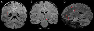 A 21-year-old patient diagnosed with relapsing–remitting multiple sclerosis with poor treatment response and positive serology for Borrelia. Coronal (A and B) and sagittal (C) imaging on a FLAIR sequence. Magnetic resonance imaging revealed multiple white matter lesions hyperintense on FLAIR with a random distribution (A–C), without showing the juxtacortical or periventricular lesion distribution typical in multiple sclerosis and without affecting the brainstem.