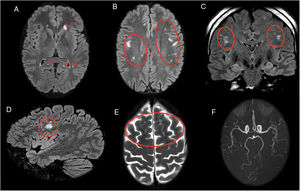 A 46-year-old patient who had psychomotor retardation for a month and developed sudden instability and migraine with aura. In view of the patient’s positive serology for Rickettsia, treatment was started with doxycycline, with subsequent clinical improvement. Axial (A and B), coronal (C) and sagittal (D) imaging on a FLAIR sequence. Axial T2-weighted imaging (E). Magnetic resonance angiography (F). This revealed punctiform foci, with a patchy distribution, in the juxtacortical white matter with a frontal predominance (A–E) and both coronae radiatae, without showing irregularities in the walls of the arteries suggestive of vasculitis at present. The patient had no cardiovascular risk factors, so Rickettsia infection was proposed as an alternative cause of microvascular involvement.