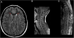 An 18-year-old patient with episodes of paralysis and sudden weakness in both legs, lasting for minutes, with no sensory abnormalities. The patient’s serology for Rickettsia was positive. (A) Axial imaging on a FLAIR sequence. (B and C) Sagittal T1-weighted fat-saturated imaging after intravenous contrast administration. Magnetic resonance imaging showed two small lesions adjacent to the head of the two caudate nuclei hyperintense on T2-weighted and FLAIR sequences and hypointense on T1-weighted sequences, with no expansiveness (A). No abnormalities are seen in the spinal cord (B and C).