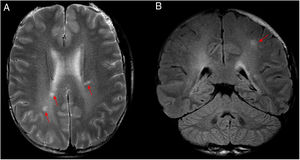 A 39-year-old patient with asthenia and non-specific generalised pain, diagnosed with relapsing–remitting multiple sclerosis and considered to have “loss of medication efficacy”. Subsequently, the patient was found to have positive serology for Rickettsia. Clinical improvement after antibiotic therapy with doxycycline supported the probable diagnosis of Rickettsia infection. (A) Axial T2-weighted imaging. (B) Coronal imaging on a FLAIR sequence. Magnetic resonance imaging showed lesions hyperintense on T2/FLAIR sequences in a periventricular location with some in the coronae radiatae (A). Another similar left parietal subcortical lesion was seen (B). They did not enhance after contrast administration (images not shown).