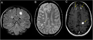 A 31-year-old patient who presented an episode of hypoaesthesia in the right arm. Cerebrospinal fluid analysis revealed oligoclonal bands; all things considered, the patient met the criteria for a diagnosis of multiple sclerosis. (A) Coronal imaging on a FLAIR sequence. (B) Axial imaging on a PD sequence. (C) Axial T1-weighted imaging after intravenous contrast administration. Magnetic resonance imaging showed numerous hyperintense ovoid white matter lesions (A–C). Some showed enhancement with punctiform morphology or open ring enhancement after intravenous contrast administration (C), thus demonstrating the temporal and spatial dissemination of the lesions.