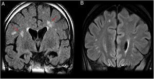 A 35-year-old patient with hypertension who had an acute psychotic episode secondary to systemic lupus erythematosus. (A and B) Coronal imaging on a FLAIR sequence. Several hyperintense foci are seen on FLAIR in the deep subcortical white matter (A) and the frontal lobes (B). Radiological signs of lupus vary widely and sometimes are highly non-specific, as in this case, and very difficult to distinguish from Lyme disease in the absence of a suitable clinical context.