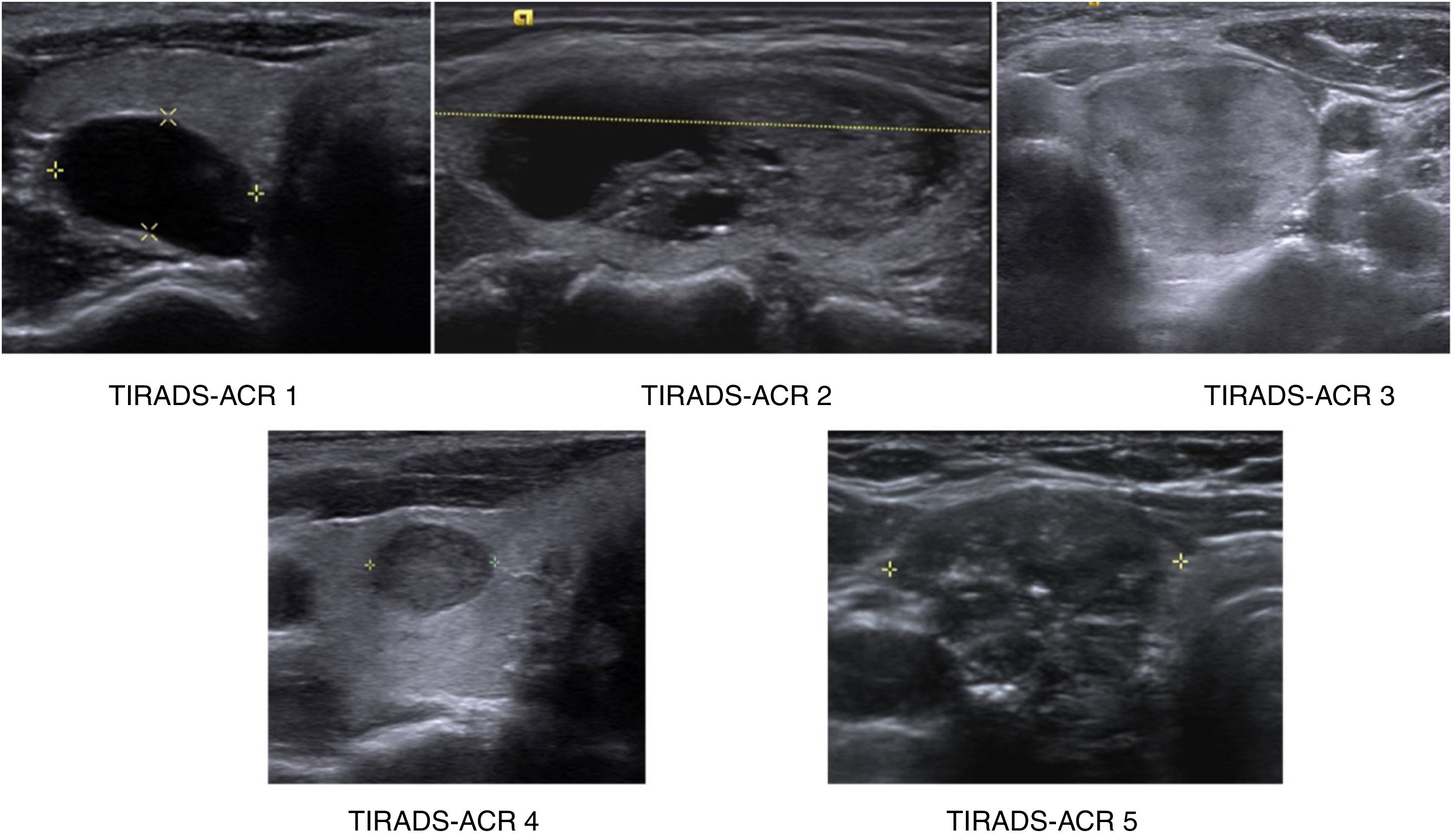 Concordance of the ACR TI-RADS | Radiología (English Edition)