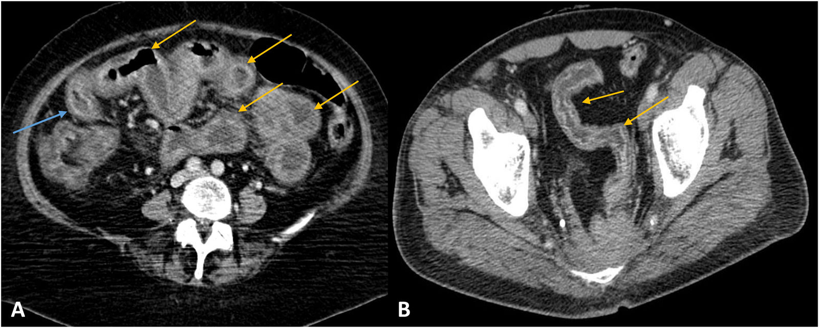 Enteritis Pattern Ct Diagnostic approach to small-bowel wall thickening: Beyond Crohn’s ...