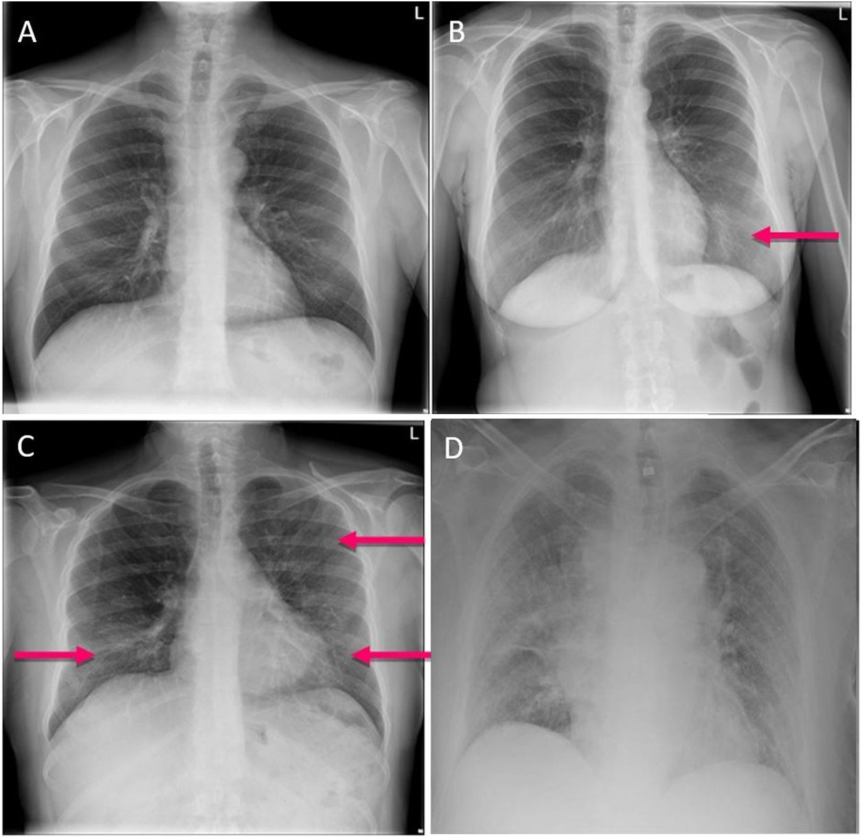 Usefulness of chest X-rays for evaluating prognosis in patients with ...