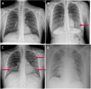 ERVI scale examples. A) Normal (ERVI 0). B) Mild, showing alveolar–interstitial opacities in a single lung field. C) Moderate, showing patchy bilateral alveolar–interstitial opacities. D) Serious, showing extensive bilateral alveolar consolidations.