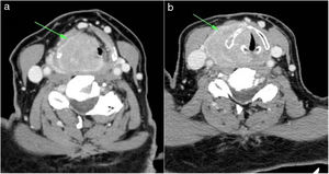 (A) Contrast enhanced axial computed tomography (CT) of the neck revealed a well demarcated, mildly enhancing, a space‑occupying lesion (arrow) of right vocal cord and arytenoid cartilage. (B) Also, the lesion extends to the preepiglottic fat space and subglottic area.