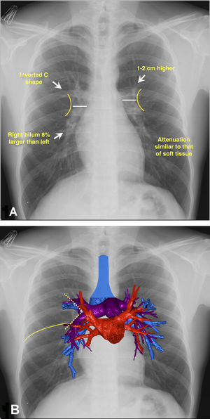 Hilar anatomy on anteroposterior chest X-rays. 1 A) The “C” shape of the hila is shown with external convexity and attenuation similar to soft tissue. 1 B) Volumetric reconstruction of computed tomography superimposed on the X-ray, with the airway (blue), pulmonary veins (red) and arteries (purple). The formation of the venolobar angle (yellow dotted line) and that of the horizontal fissure (solid yellow line) are also seen.