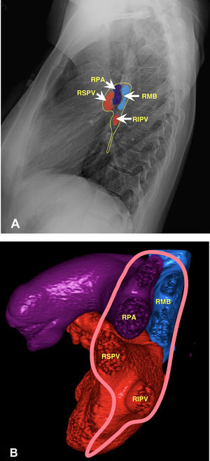 Anatomy of the right hilum. 2 A) Chest X-ray in lateral view illustrating the normal anatomical relationships of veins, artery and bronchus. 2 B) Volumetric reconstruction of computed tomography. Delimitation of the pleural insertion of the right hilum (pink line) comprising bronchus (blue), veins (red) and pulmonary artery (purple). In the upper part the pulmonary artery is anterior and the bronchus posterior to that, while the pulmonary veins are in the inferior part. RPA: right pulmonary artery; RMB: right main bronchus; RIPV: right inferior pulmonary vein; RSPV: right superior pulmonary vein.