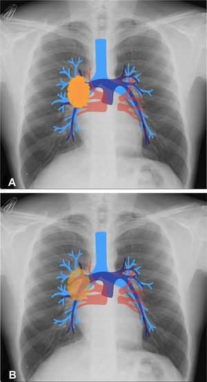 Hilum overlay sign. 4 A) Diagram representing a mass in a hilar position (orange oval) erasing the view of the vessels. 4 B) Diagram showing a localised mass in an extrahilar position. The vessels can be seen through the lesion, but whether the lesion is in front of or behind the hilum cannot be determined.