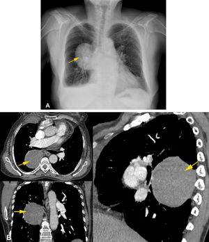 Posterior mediastinal mass in a 78-year-old woman. 6 A) Anteroposterior chest X-ray which allows the hilar vessels to be seen through the lesion without erasing their contours. It is inferred that the mass is not located in the hilum (yellow arrow). 6 B) Computed tomography with contrast of the chest on axial, coronal and sagittal planes, showing a solid, rounded mass with attenuation of soft tissues in contact with the spine and located in the posterior mediastinum (yellow arrows). Histopathology study showed a nerve sheath tumour. Courtesy of Dr Lya Pensado, Instituto Nacional de Enfermedades Respiratorias [Spanish Institute of Respiratory Diseases] (INER). Cortesía de la Dra. Lya Pensado, INER.