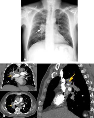 Hilar mass in a 62-year-old patient. 7 A) Anteroposterior chest X-ray showing a prominent and increased right hilum in which the hilar vessels cannot be distinguished from the lesion (white arrow). 7 B) Contrast computed tomography of the chest on axial, coronal and sagittal planes confirming the position of the lesion at the hilum, encompassing arteries, veins and bronchi (yellow arrows). Histopathology reported small-cell neuroendocrine carcinoma. Courtesy of Dr Lya Pensado, INER.