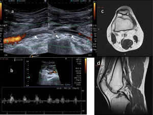 A and B) Doppler ultrasound. Subocclusion of the popliteal artery with very weak blood flow in a young patient with popliteal artery entrapment syndrome and signs and symptoms of intermittent claudication. C and D) Non–contrast-enhanced magnetic resonance imaging, axial and sagittal projections, respectively. Abnormal insertion of the medial gastrocnemius muscle, the tendon of which ascends more than normal, passing between the popliteal artery and vein and inserting in the posterior cortex of the femoral metaphysis, where a benign bony outgrowth has formed. Modified Love and Whelan II classification.