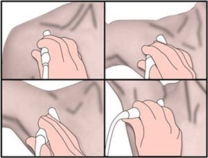 Modified Adson’s manoeuvre: with the patient seated, place the transducer below the clavicle, in the costoclavicular space. Assess the subclavian artery and vein in a neutral position and in progressive abduction/hyperabduction while performing contralateral extension of the neck.