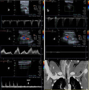 A) Normal arterial blood flow in a neutral position of the subclavian artery. B) Duplication of PSV in the subclavian artery in 90-degree abduction in thoracic outlet syndrome (TOS). C) Normal venous blood flow in a neutral position of the subclavian vein. D) Loss of respiratory dynamics in the subclavian vein with abduction manoeuvres in TOS. E) Normal radial artery wave in a neutral position and attenuated with Adson