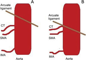 Figure A shows normal anatomy. Figure B shows how the arcuate ligament is in contact with the outlet of the coeliac trunk. CT: coeliac trunk; IMA: inferior mesenteric artery; SMA: superior mesenteric artery.