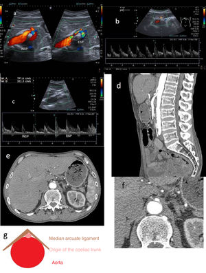 A) Hook-shaped coeliac trunk with change in orientation in relation to inspiration and expiration. B) Coeliac trunk with elevation of peak systolic velocities >200 cm/s. C) In expiration, the velocity increases from 192 to 322 cm/s. D) CT angiography: (expiration) focal stenosis of the proximal portion of the coeliac trunk (hooked appearance). E and F (detail): CT angiography (arterial phase) showing the “hair bun and shawl” sign. G) “Hair bun and shawl” sign.