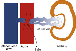 Anatomy of nutcracker syndrome. SMA: superior mesenteric artery.