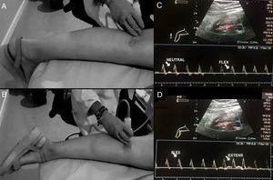 Stress manoeuvres for assessing popliteal artery entrapment syndrome. Patient in prone decubitus, with the leg extended and the ankle in dorsiflexion (A) and plantar extension (B) for 30 seconds. The radiologist can help to maintain the posture by applying pressure. The presence or absence of or changes in blood flow will be evaluated all along the path of the popliteal artery with changes in position. C and D show normal findings on spectral Doppler ultrasound with flexion and extension stress manoeuvres.