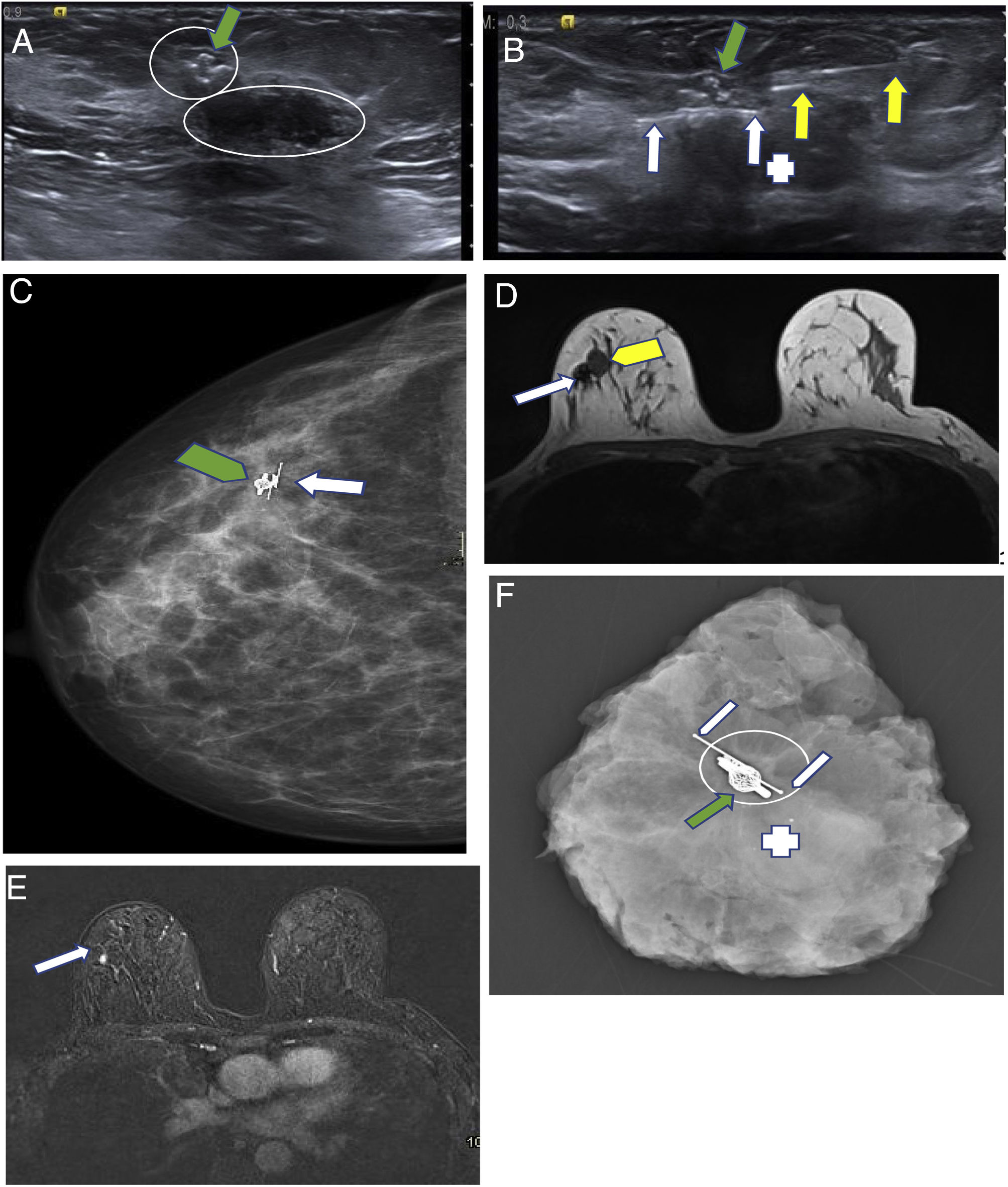 Ultrasound guided Interventional Procedures In Breast Imaging ultrasound-guided-interventional-procedures-in-breast-imaging