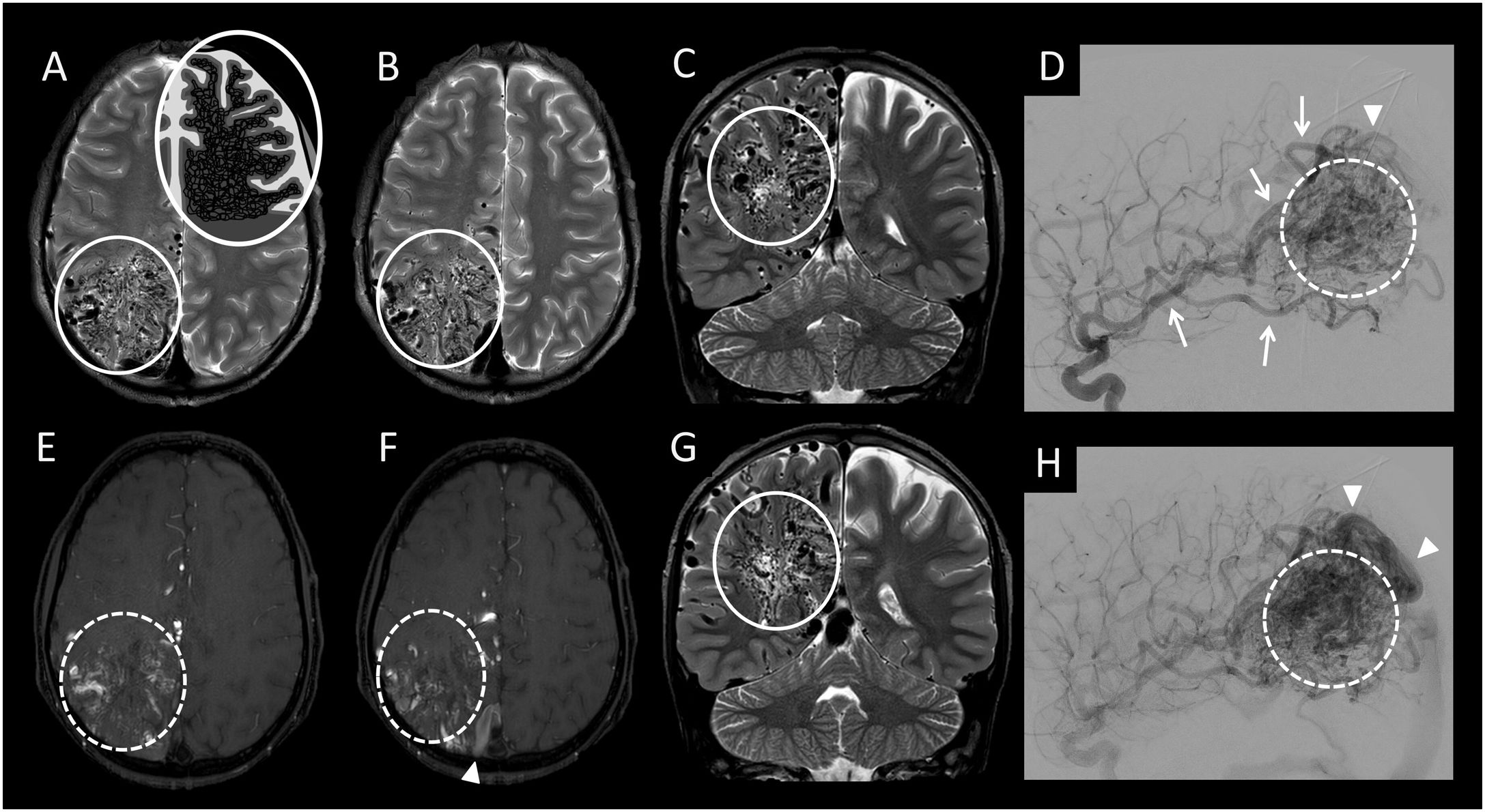 Avm Leg Anomalous location of intracranial vessels in adults | Radiología ...