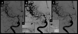 Admission angiography (A) showed a normal caliber of intracranial vessel and a terminal internal carotid aneurysm. Eight days later, pretreatment angiography (B) showed spasm of the intracranial vessel in the internal carotid artery, the anterior cerebral artery and the middle cerebral artery. After stent-retriever angioplasty in the middle cerebral artery and the internal carotid artery (C) and in the anterior cerebral artery (D), posttreatment angiography (E) showed an improvement in the caliber of the three vessels.