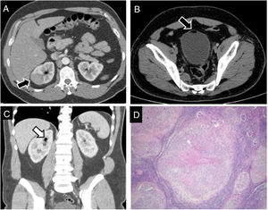 A. Contrast-enhanced venous phase CT images (A, B axial; C, coronal view) show a hypoattenuated focal lesion (arrow) in the upper pole of the right kidney. B, C. Presence of gas into the bladder (arrow in B) and the superior collector system (arrow in C) is seen that presumes vesicoureteral reflux after transurethral resection. D. Low power examination of renal parenchyma revealing the presence of multiple nodular lesions throughout the whole specimen (hematoxylin and eosin staining, 4×).