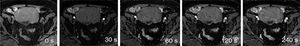 Dynamic sequence. Example in which the different phases can be seen with image acquisition prior to the administration of gadolinium and, after that, at 30, 60, 120 and 240s.