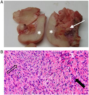 A) Macroscopic specimens from both ovaries following surgery. The right ovary (left side of image) and the left ovary (right side of image), previously fragmented, enabling visualisation of a peripheral ridge of homogeneous whitish tissue exhibiting an elastic consistency, consistent with fibrotic tissue (asterisks). The centre is composed of yellowish stroma with vessels (arrow). The macroscopic findings are consistent with bilateral ovarian fibromatosis. B) Haematoxylin-eosin staining at 40x magnification of the ovary showing replacement of more than 90% of the parenchyma with fusocellular proliferation (black arrow) forming intertwined bundles with variable areas of collagen and stromal oedema (hollow arrow).