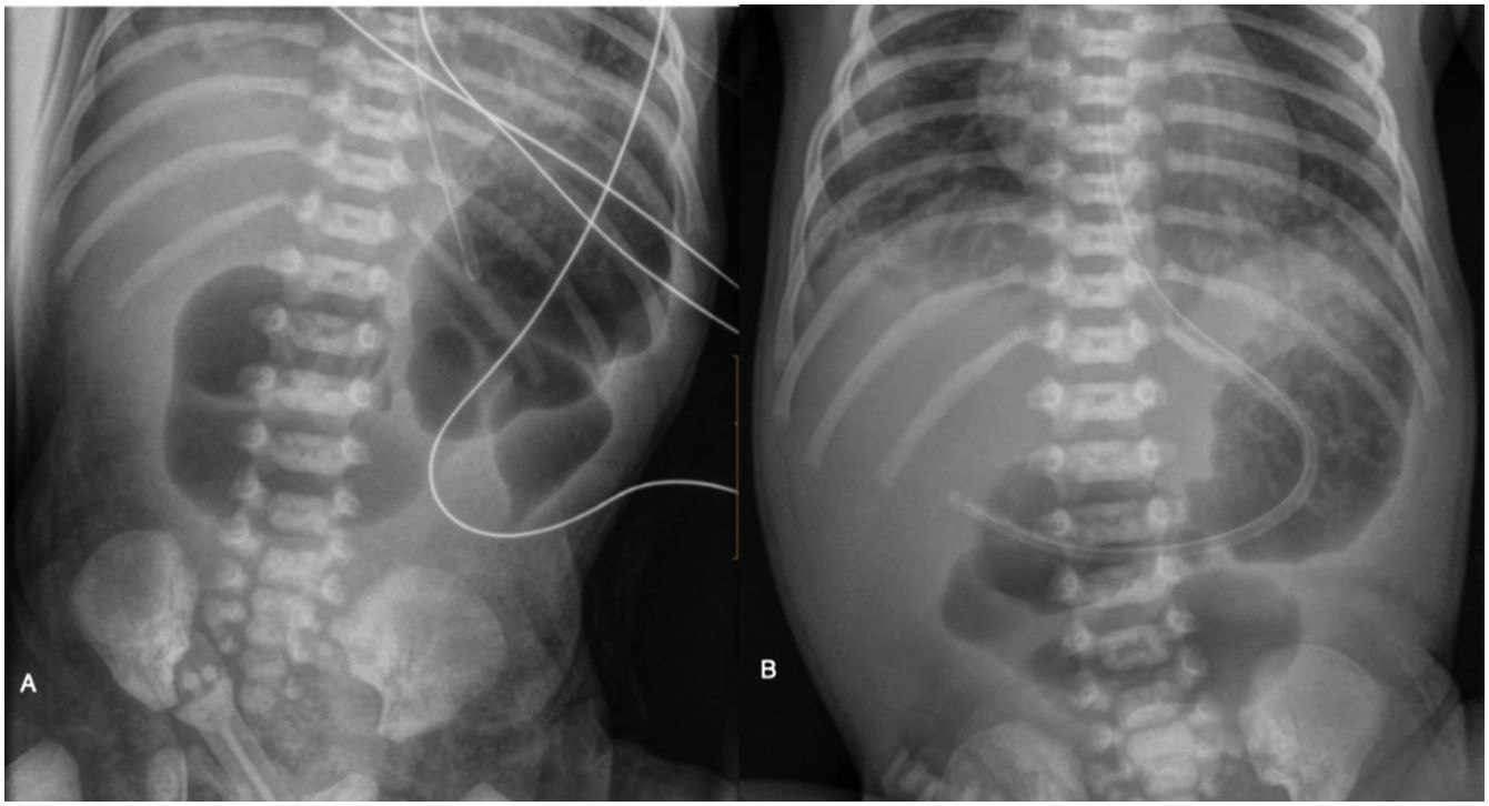 Small bowel Atresias A Case Series With Review Of The Disease And small-bowel-atresias-a-case-series-with-review-of-the-disease-and