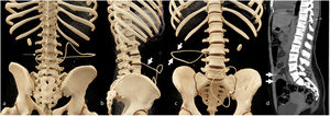 Imaging of the normal path of the LPS without a valve. 3D reconstruction of non–contrast-enhanced abdominal and pelvic CT with posterior, lateral and anterior views (a-c) and maximum intensity projection (MIP) on the midsagittal plane (d) showing the arrangement of the different parts of the LPS without a valve. a) Inlet into the spinal canal through the L2-L3 space (thin arrow). b-d) These show the path of the catheter in the subcutaneous cellular tissue of the right flank from back to front (thick arrows). c and d) These show the pelvic and intraspinal ends of the LPS at T10-T11, respectively (dashed arrows). A capsule in the bowel loops is incidentally visualised.