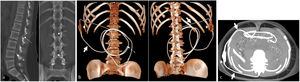Imaging of the normal path of the LPS with a valve. Sagittal and coronal MIP reconstruction (a), 3D anterior and posterior oblique reconstruction (b) and transverse multiplanar reconstruction based on MIP imaging (MipPR) (c) of non–contrast-enhanced abdominal and pelvic CT without contrast, showing the arrangement of the different parts of the LPS with a valve. a) Inlet into the spinal canal through the L1-L2 space (thin arrow), with the cable coiled inside the canal and the end at the L4 level (dashed arrow). b and c) These show the lumbar path of the catheter in the subcutaneous cellular tissue of the right flank up to the peritoneal path (thick arrows), with right subcostal internalisation and a coiled intra-abdominal path. Central abdominal end (dashed arrow). Subcutaneous valve device in right flank (*).