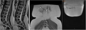 Imaging of LPS on MRI. Sagittal imaging at two adjacent levels in a T2-weighted SE sequence (a) and coronal posterior and anterior imaging in a T1-weighted SE sequence (b). Path of the LPS catheter from inside the lumbar spinal canal with the end at the L4-L5 level, exiting between L2 and L3 (arrows) (a) to the posterior subcutaneous path (arrows) and entering the peritoneum in a right paraumbilical location (dashed arrow) (b). Note the panniculus as these patients are usually overweight. The LPS has low signal intensity on all sequences.