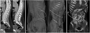 Imaging of LPS disconnection. Abdominal CT, sagittal MIP (a), 3D posterior and lateral oblique (b) and anteroposterior (c) reconstructions. a) An LPS is seen inside the spinal canal with the upper end at T7; note that the end has a millimetric tip with a higher density (black arrow) and observe the disconnected end inside the spinal canal between S1 and S2, with no higher-density tip (white arrow). The lumbar valve path has migrated into the spinal canal. b) The images show the absence of the lumbar path of the LPS from the posterior midline to the valve and the patency of the path from the valve to the peritoneal inlet in a paraumbilical location. c) Path of the intra-abdominal LPS with its end at the midline (dashed arrow).