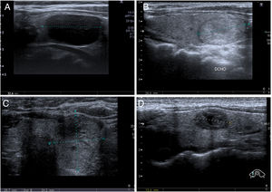 Diagnostic categories for core needle biopsy (CNB) of the thyroid. A) Insufficient (I): 58-year-old woman. Nodule with intermediate ultrasound suspicion of malignancy (solid and hypoechoic nodule, oval in shape and without microcalcifications) and a diameter greater than 1cm. CNB with insufficient result. In the multidisciplinary unit (MU) it was decided to perform diagnostic lobectomy, resulting in papillary carcinoma with free margins, in the context of colloid nodule and goitre. B) Benign (B): 56-year-old woman. Nodule with low ultrasound suspicion of malignancy (solid and isoechoic, oval in shape and without microcalcifications) and a diameter greater than 1.5cm. CNB with result of adenomatous hyperplasia. Subsequent ultrasound stability for 18 months. C) Follicular proliferation (FP): 55-year-old woman. Nodule with high ultrasound suspicion of malignancy (solid and isoechoic, without microcalcifications, but "thicker than it is wide in the axial plane) and a diameter greater than 1cm. CNB with result of follicular cell proliferation. Follicular carcinoma was diagnosed in surgery. D) Malignancy (M): 34-year-old woman. Nodule with high ultrasound suspicion of malignancy (solid and hypoechoic, with a small central cystic area and microlobulated margins) and a diameter greater than 1cm. A fine needle aspiration biopsy was performed, it was classified as Bethesda III, and at the MU it was decided to perform CNB, the result of which was medullary carcinoma, later confirmed by surgery.gr2