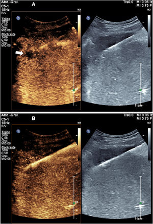 Biopsy of liver metastasis not visible on conventional ultrasound. A) The two-window image shows the lesion (arrow) visible in the contrast window. In that window, the biopsy needle is almost indistinguishable, but it is perfectly visible in the conventional ultrasound window. B) The biopsy was successfully completed.
