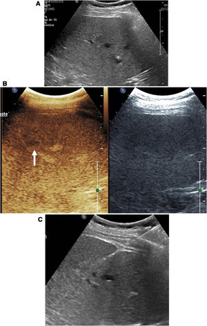 Liver metastases in which ultrasound-guided biopsy was indicated. A) When ultrasound was performed, the lesion was not clearly identified, and so a decision was made to perform contrast-enhanced ultrasound. B) Contrast-enhanced ultrasound enabled the lesion to be identified (arrow). C) Once the lesion was identified, it was successfully targeted in biopsy.