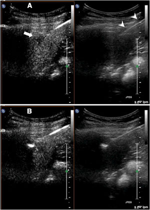 Ablation of liver metastasis not visible on conventional ultrasound. A) The lesion (arrow) is only visible in the contrast window. In the conventional ultrasound window, the ablation needle is better identified (arrow tips). B) The ablation has begun. Echogenic bubbles can be seen to form at the tip of the needle.