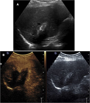 Follow-up check 24h after microwave ablation of a liver metastasis. A) Ultrasound shows the characteristic parallel-line image of the microwave ablation tract. The extent of the treated area cannot be determined. B) Contrast-enhanced ultrasound enables identification of the coagulated area, which does not enhance.