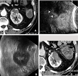 Incomplete ablation of renal carcinoma. Computed tomography (A) and ultrasound (B) of the kidney showing a solid tumour. A decision was made to pursue treatment with radiofrequency ablation. C) Contrast-enhanced ultrasound performed 24h after ablation showed a crescent of uptake on the periphery of the treated tumour (arrow tips), indicating incomplete ablation. D) The tomography subsequently performed showed exactly the same finding (arrow tips).