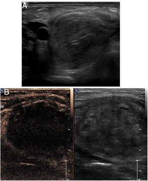 Thyroid ablation. A) Thyroid nodule before ablation. B) Folow-up check one month after ablation. The lack of contrast uptake by the treated nodule can be seen.